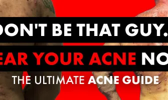 ACNÉ AND STEROIDS